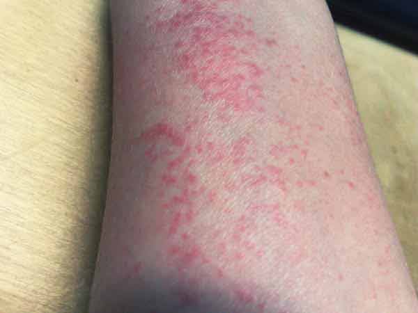 Sweat And Stump Skin Rash Stump Care Technical Right Below Elbow Amputee Issues